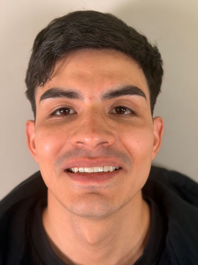 Implantes dentales en Bencomo Dental Clinic